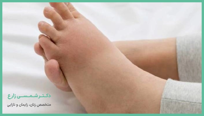 ورم پا بعد از زایمان سزارین چه علتی دارد؟